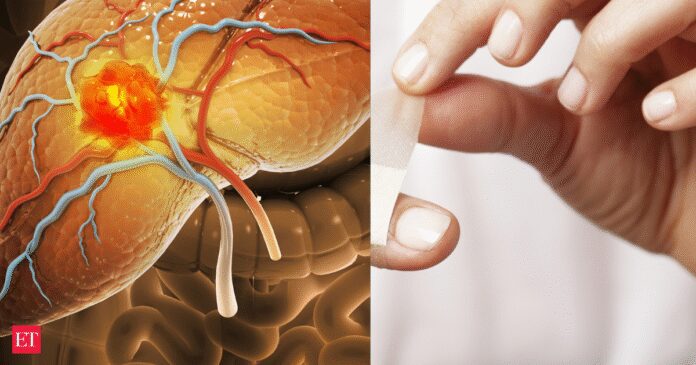 Liver Cirrhosis risk? Check your nails, this common condition might be telling you something